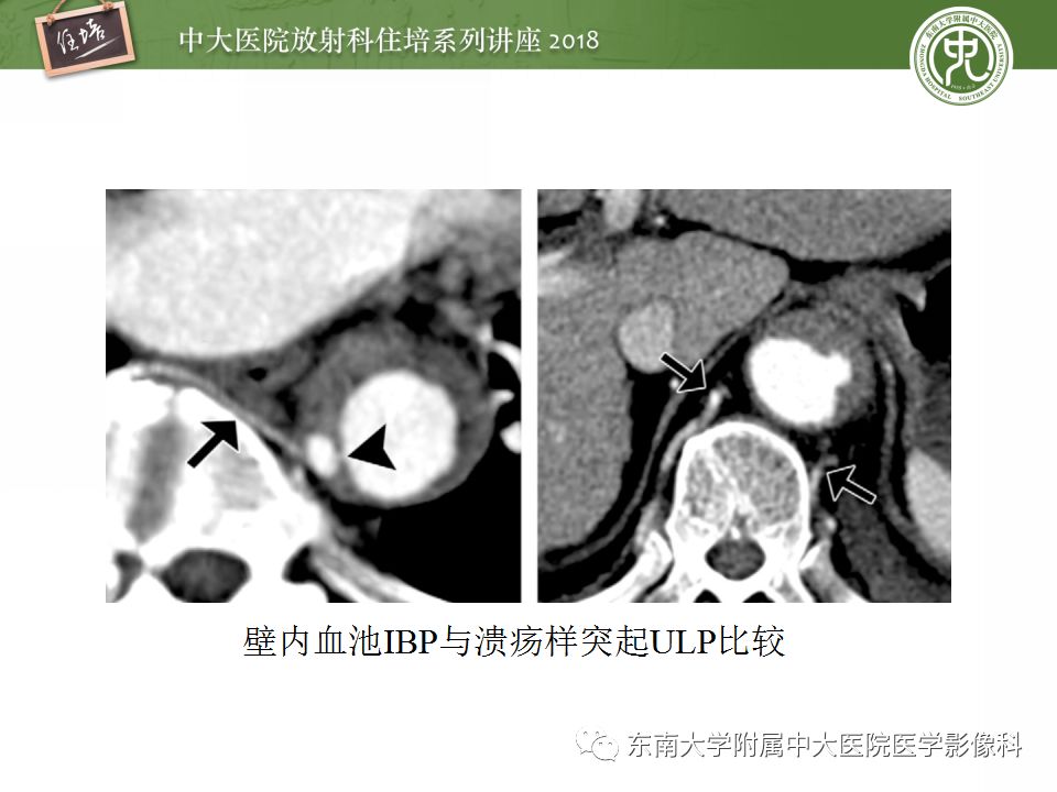 【PPT】急性主动脉综合征的CTA诊断与高风险征象