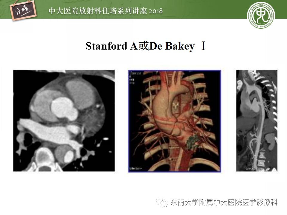 【PPT】急性主动脉综合征的CTA诊断与高风险征象