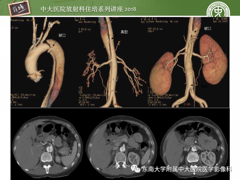 【PPT】急性主动脉综合征的CTA诊断与高风险征象