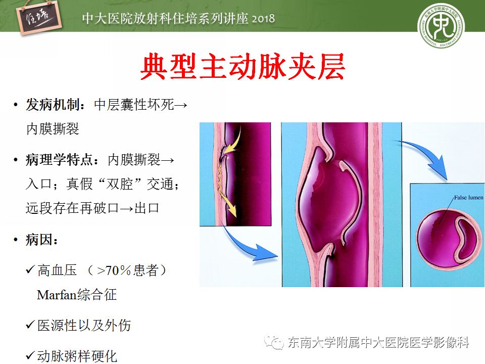 【PPT】急性主动脉综合征的CTA诊断与高风险征象