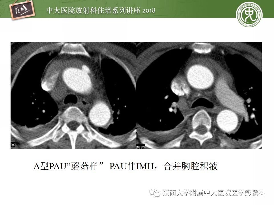 【PPT】急性主动脉综合征的CTA诊断与高风险征象