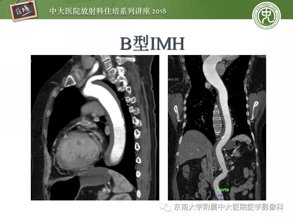 【PPT】急性主动脉综合征的CTA诊断与高风险征象