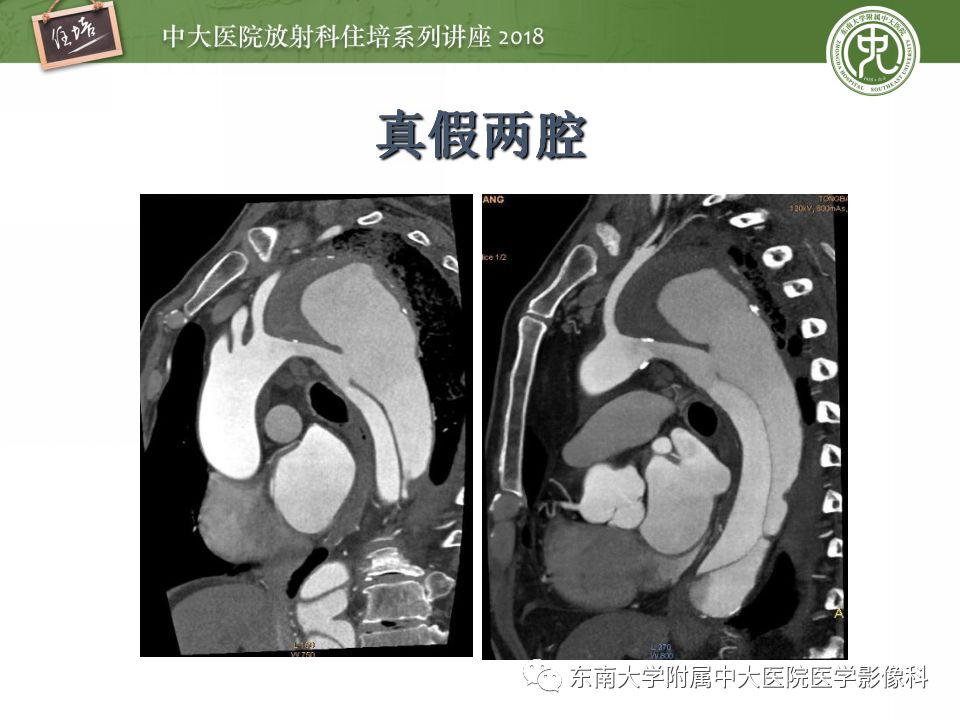 【PPT】急性主动脉综合征的CTA诊断与高风险征象