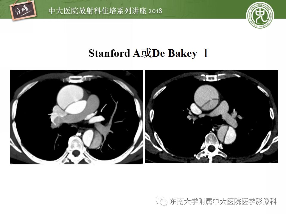 【PPT】急性主动脉综合征的CTA诊断与高风险征象