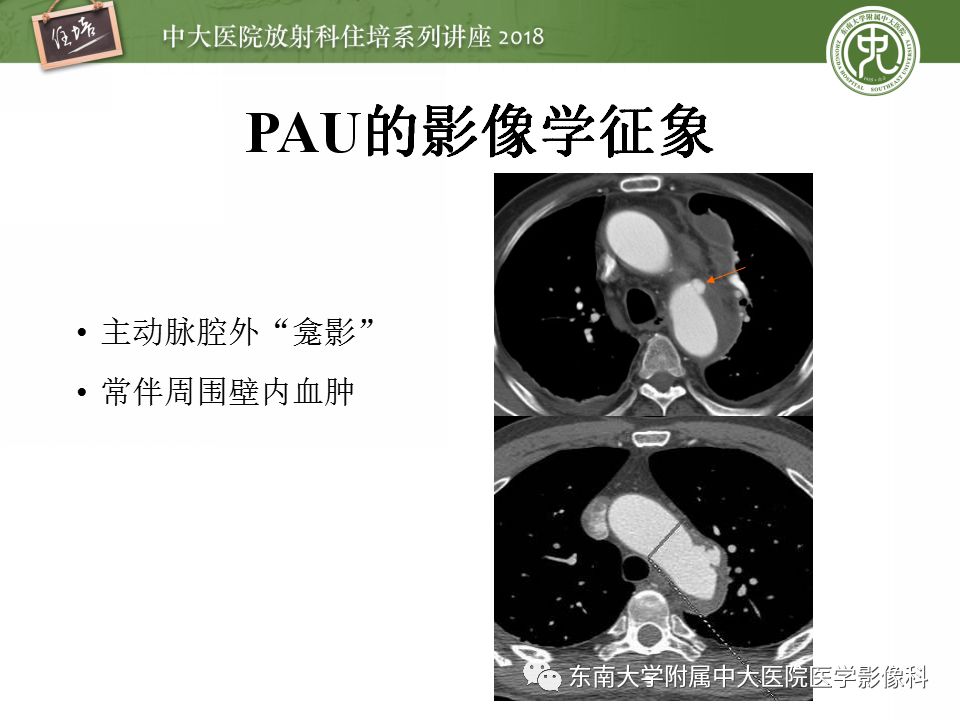 【PPT】急性主动脉综合征的CTA诊断与高风险征象