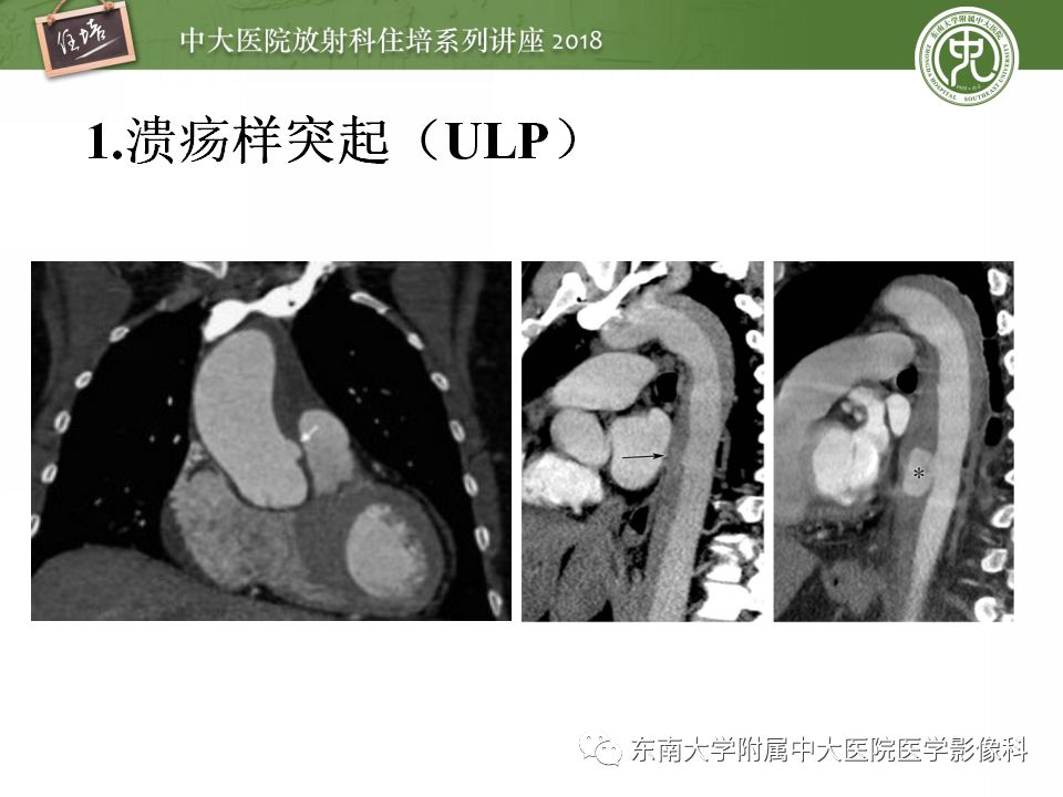 【PPT】急性主动脉综合征的CTA诊断与高风险征象