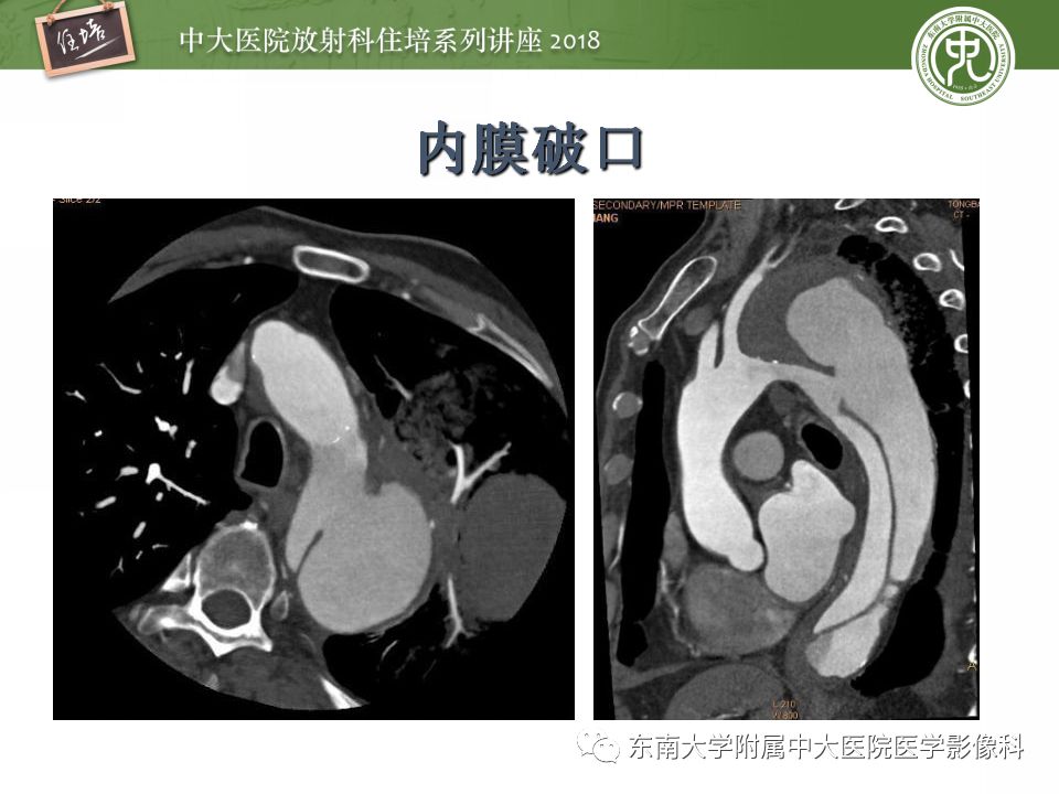 【PPT】急性主动脉综合征的CTA诊断与高风险征象