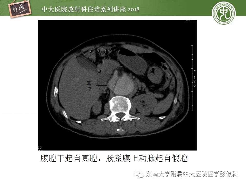 【PPT】急性主动脉综合征的CTA诊断与高风险征象