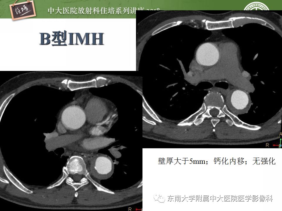 【PPT】急性主动脉综合征的CTA诊断与高风险征象