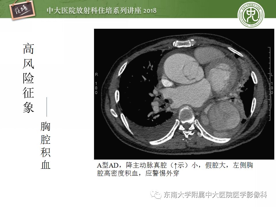 【PPT】急性主动脉综合征的CTA诊断与高风险征象