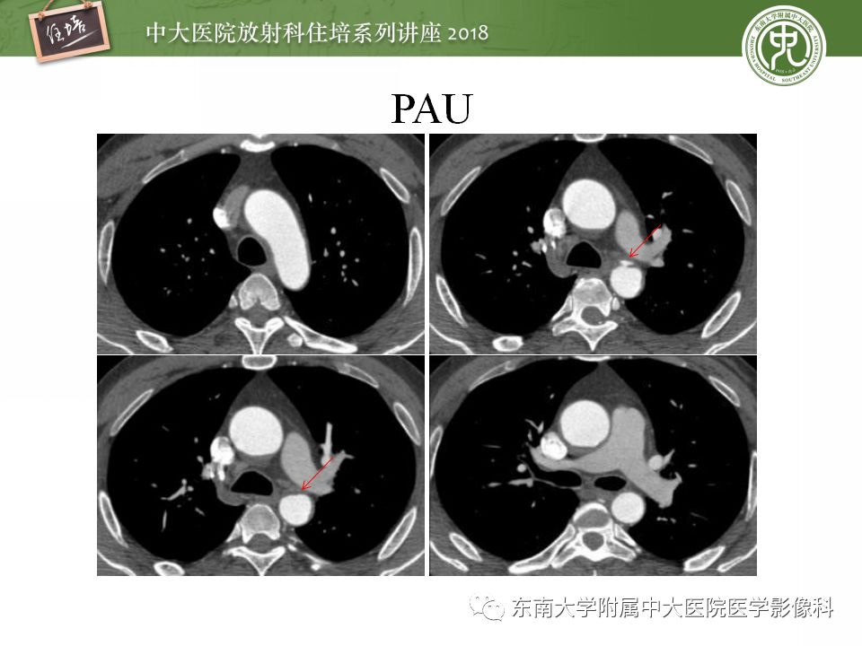 【PPT】急性主动脉综合征的CTA诊断与高风险征象