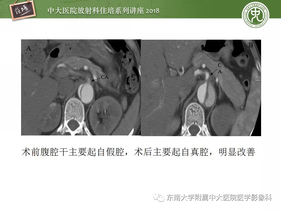 【PPT】急性主动脉综合征的CTA诊断与高风险征象