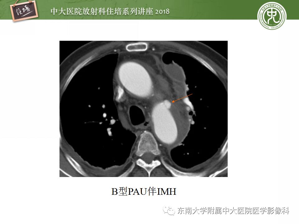 【PPT】急性主动脉综合征的CTA诊断与高风险征象