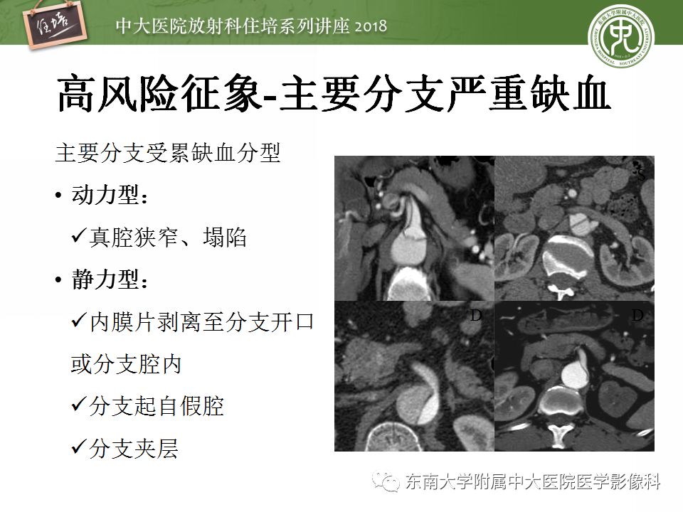 【PPT】急性主动脉综合征的CTA诊断与高风险征象