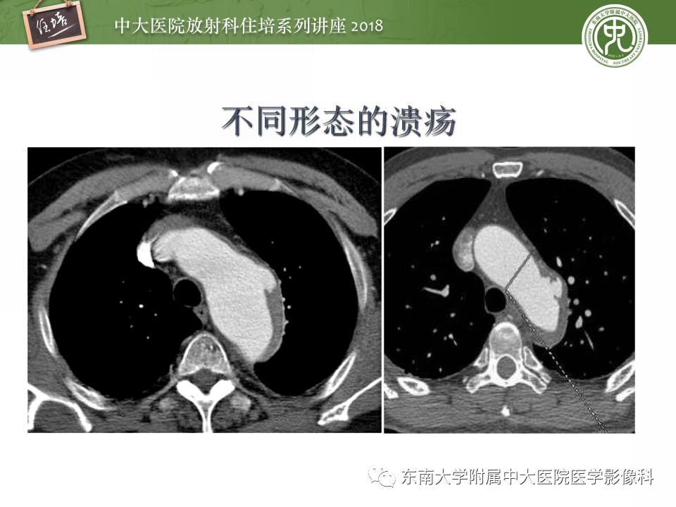 【PPT】急性主动脉综合征的CTA诊断与高风险征象