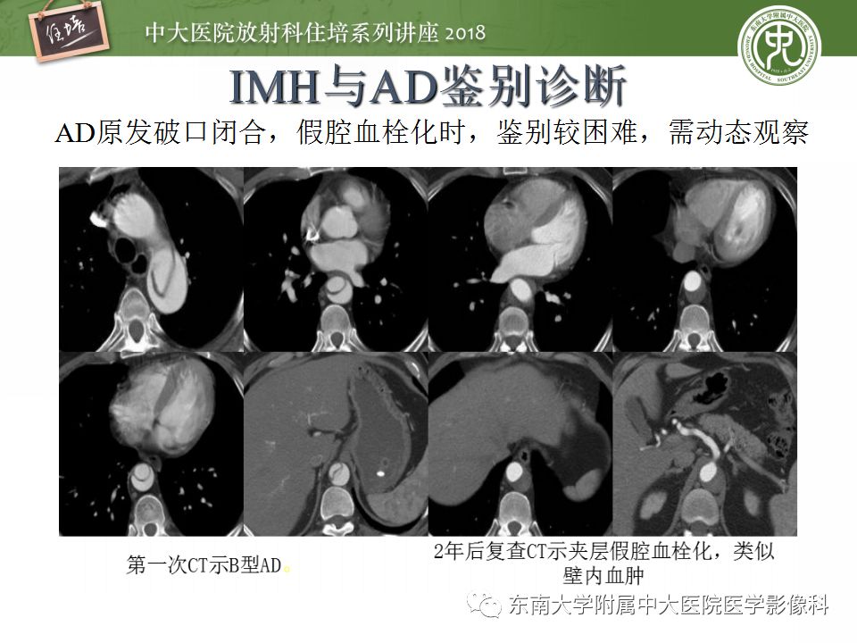 【PPT】急性主动脉综合征的CTA诊断与高风险征象