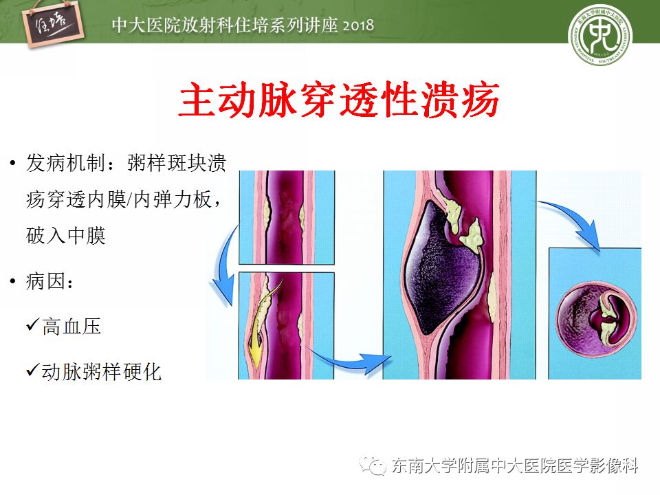 【PPT】急性主动脉综合征的CTA诊断与高风险征象