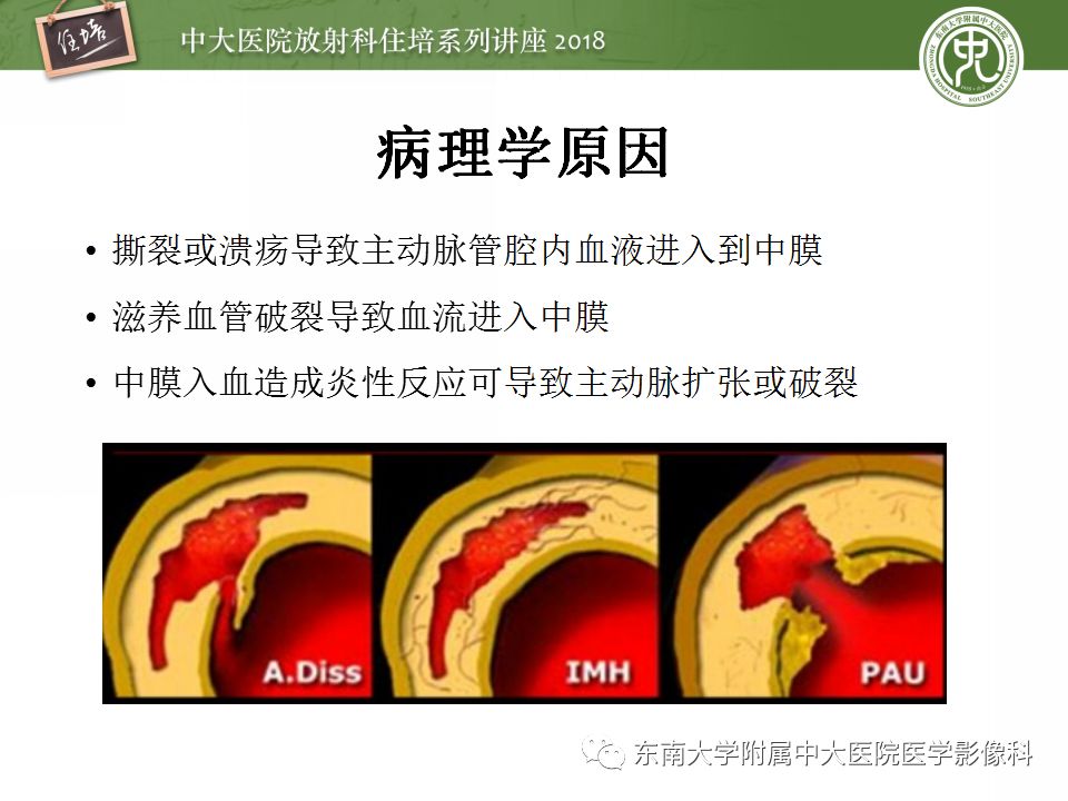 【PPT】急性主动脉综合征的CTA诊断与高风险征象