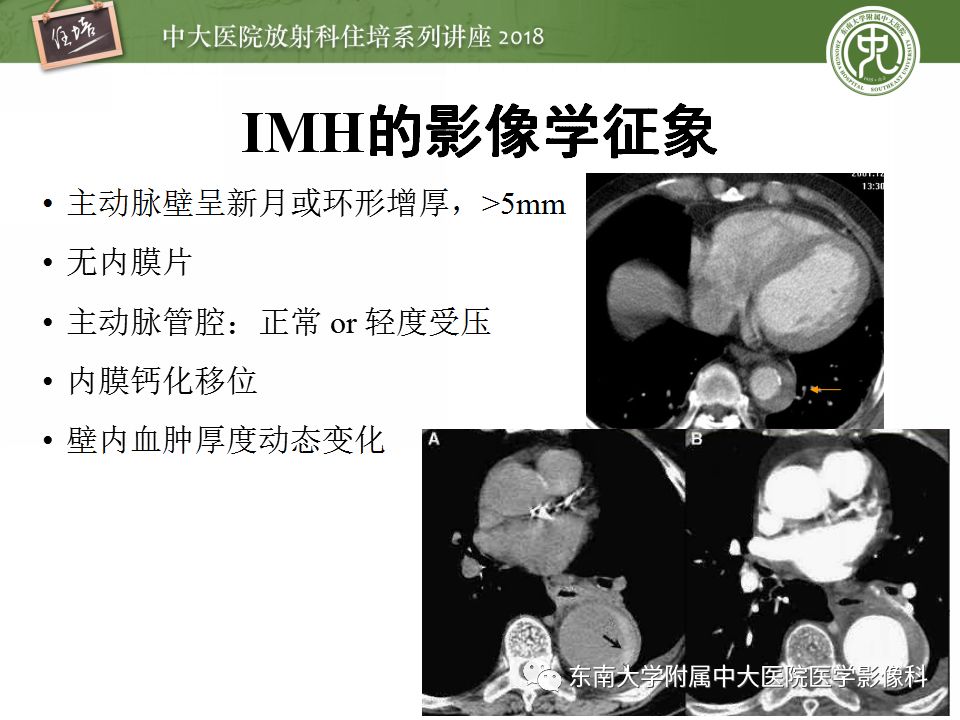 【PPT】急性主动脉综合征的CTA诊断与高风险征象