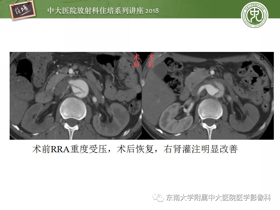 【PPT】急性主动脉综合征的CTA诊断与高风险征象