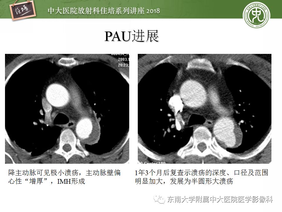 【PPT】急性主动脉综合征的CTA诊断与高风险征象