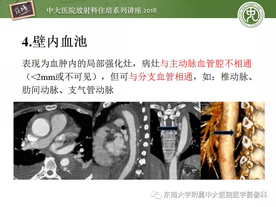 【PPT】急性主动脉综合征的CTA诊断与高风险征象
