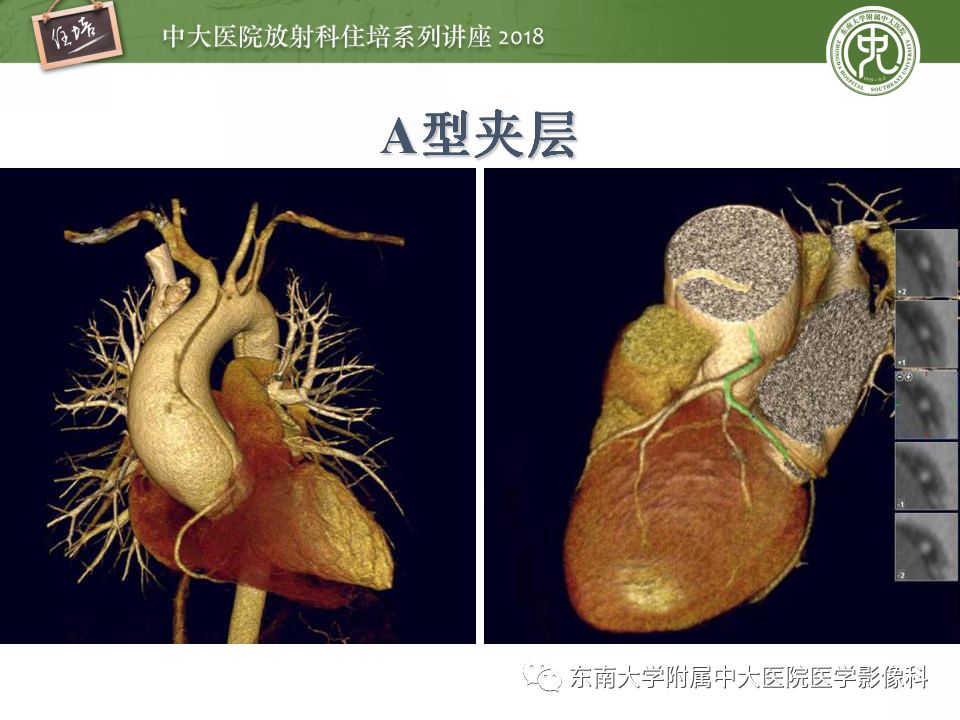 【PPT】急性主动脉综合征的CTA诊断与高风险征象