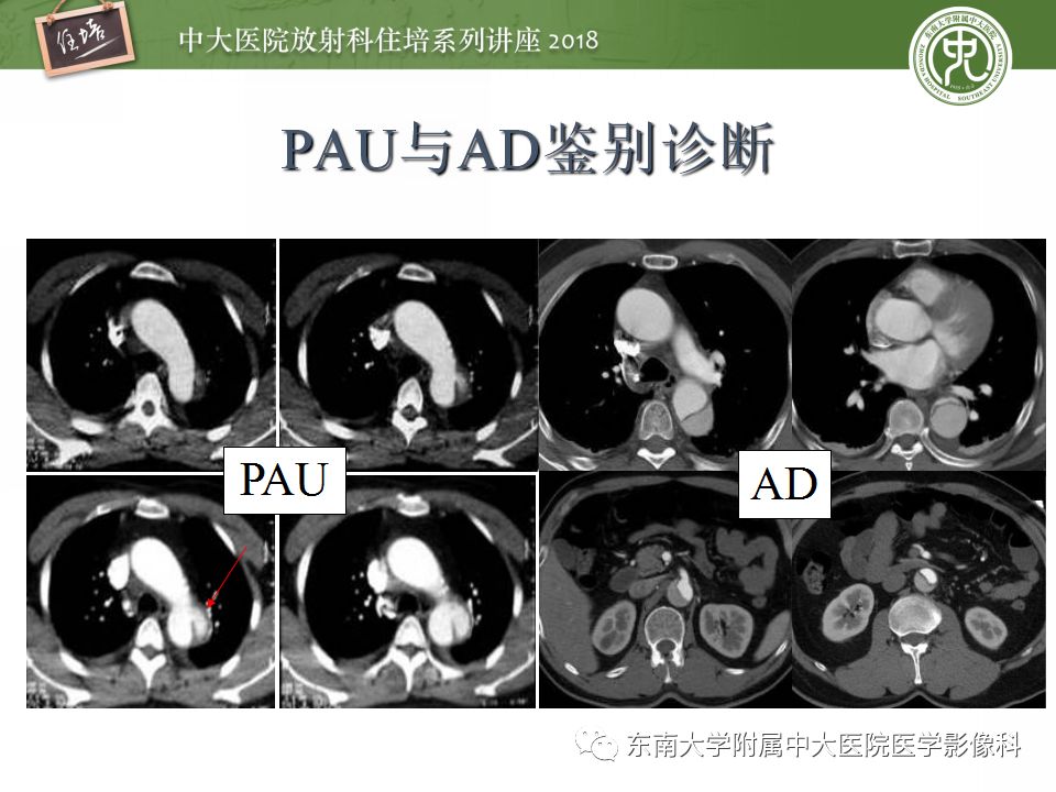 【PPT】急性主动脉综合征的CTA诊断与高风险征象