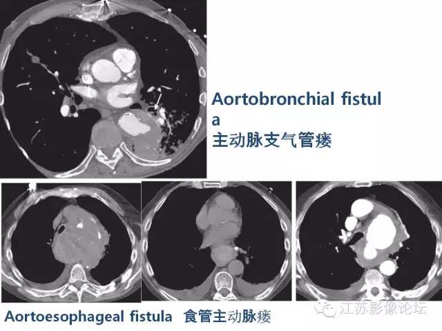 【PPT】急诊室经常遇到的急性主动脉疾病