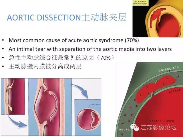 【PPT】急诊室经常遇到的急性主动脉疾病