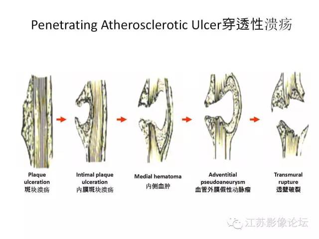 【PPT】急诊室经常遇到的急性主动脉疾病