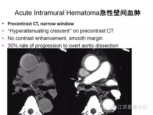 【PPT】急诊室经常遇到的急性主动脉疾病