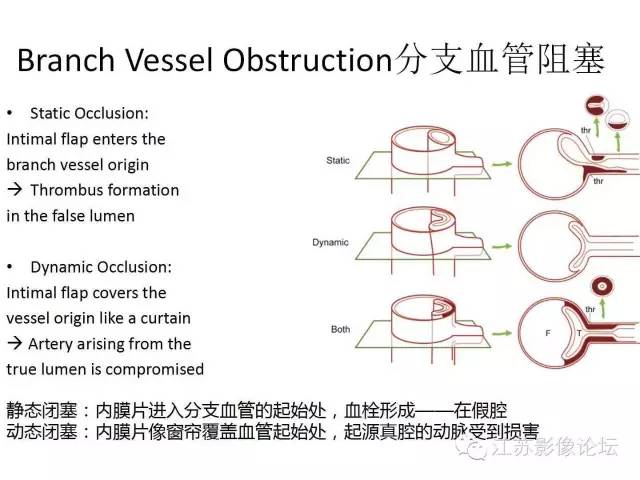 【PPT】急诊室经常遇到的急性主动脉疾病