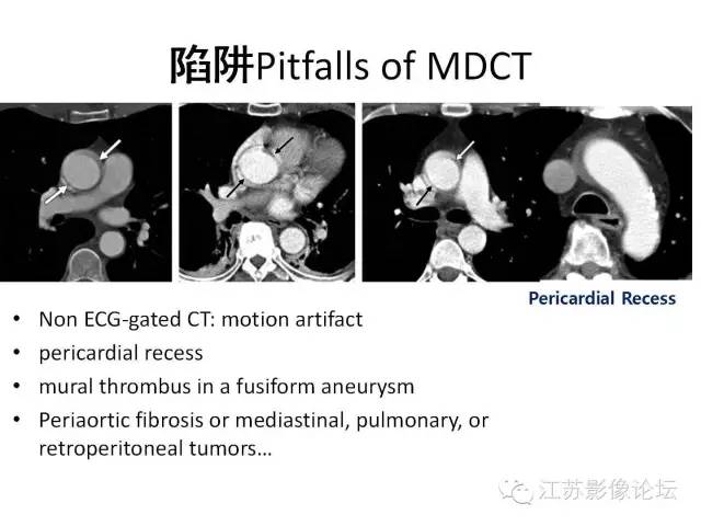 【PPT】急诊室经常遇到的急性主动脉疾病