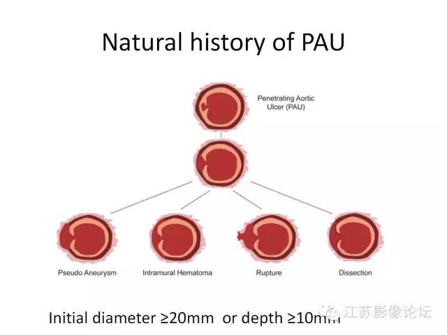 【PPT】急诊室经常遇到的急性主动脉疾病