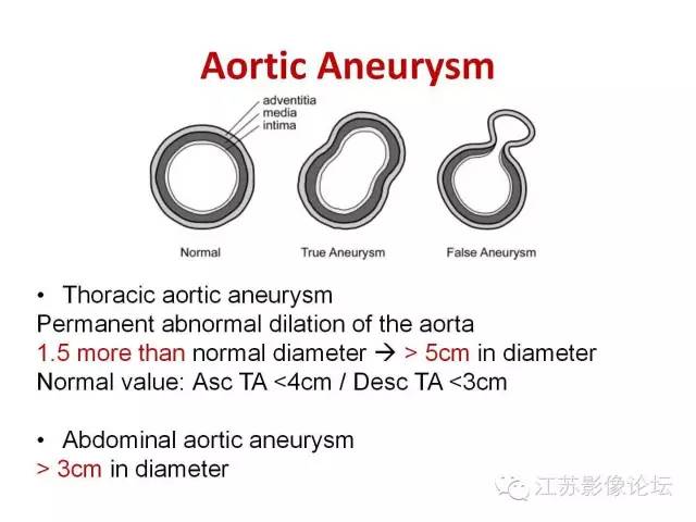 【PPT】急诊室经常遇到的急性主动脉疾病
