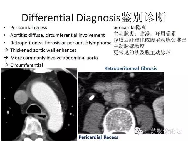 【PPT】急诊室经常遇到的急性主动脉疾病