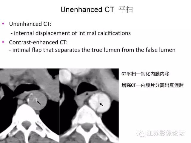 【PPT】急诊室经常遇到的急性主动脉疾病