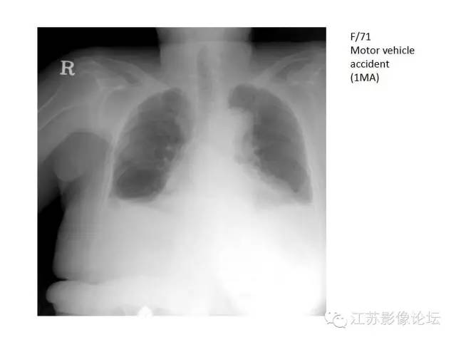 【PPT】急诊室经常遇到的急性主动脉疾病
