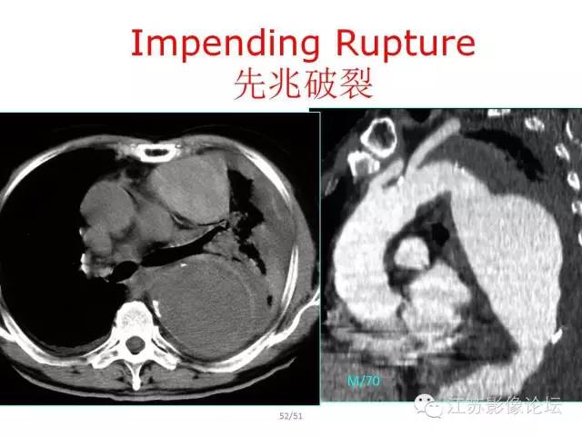 【PPT】急诊室经常遇到的急性主动脉疾病