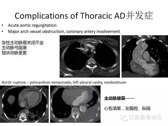【PPT】急诊室经常遇到的急性主动脉疾病