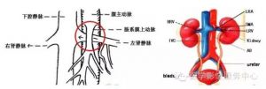 左肾静脉压迫综合征