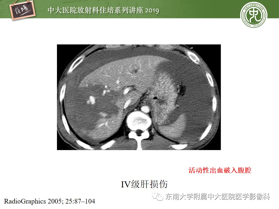 【PPT】腹腔实性脏器钝性外伤影像诊断