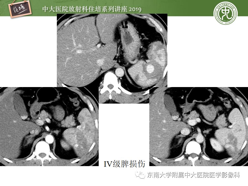 【PPT】腹腔实性脏器钝性外伤影像诊断