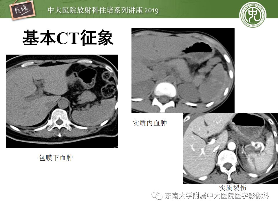 【PPT】腹腔实性脏器钝性外伤影像诊断