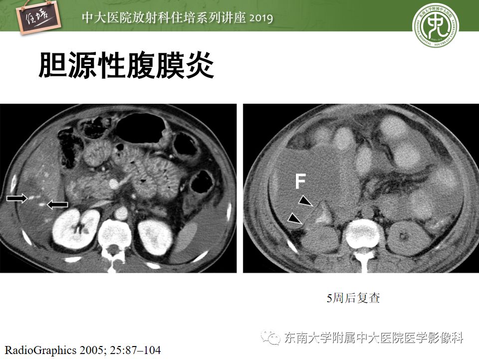 【PPT】腹腔实性脏器钝性外伤影像诊断