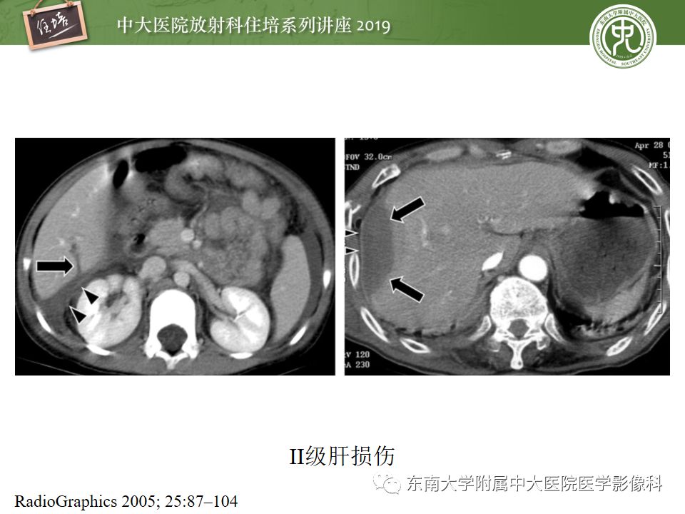 【PPT】腹腔实性脏器钝性外伤影像诊断