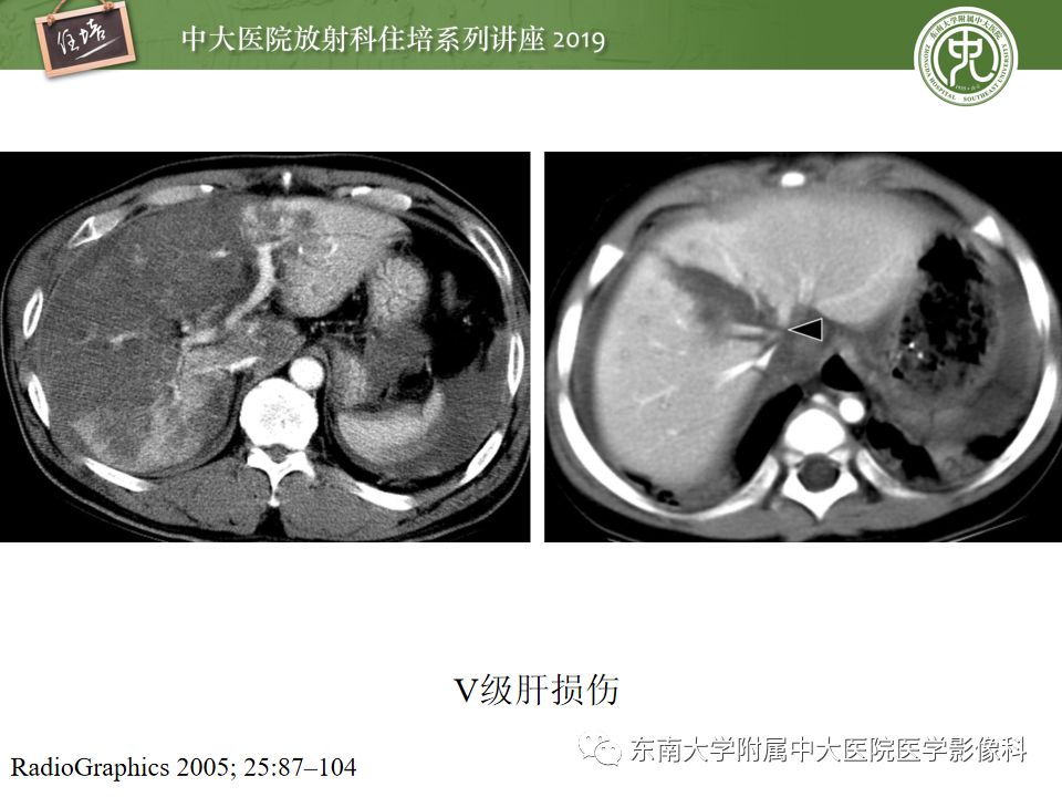 【PPT】腹腔实性脏器钝性外伤影像诊断