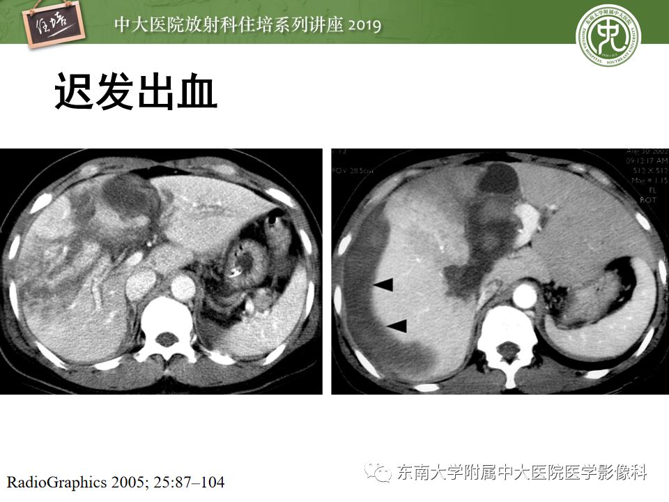 【PPT】腹腔实性脏器钝性外伤影像诊断