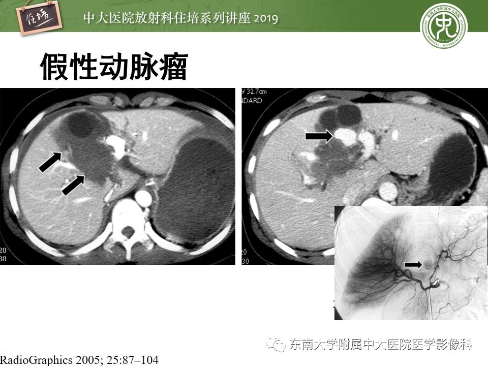 【PPT】腹腔实性脏器钝性外伤影像诊断